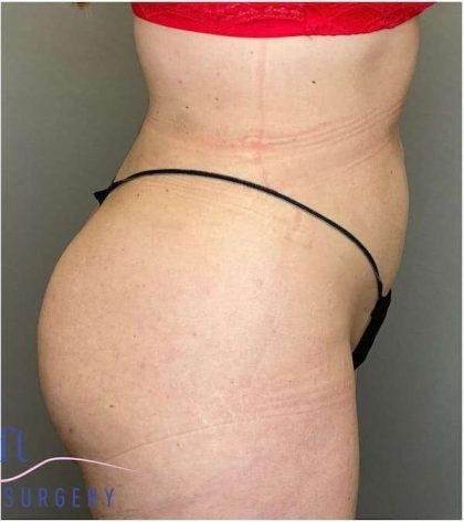Liposuction Before & After Patient #166