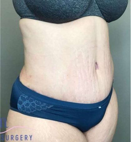 Tummy Tuck Before & After Patient #314