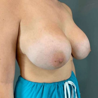 Breast Augmentation Before & After Patient #1384