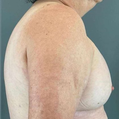 Breast Augmentation Before & After Patient #1450