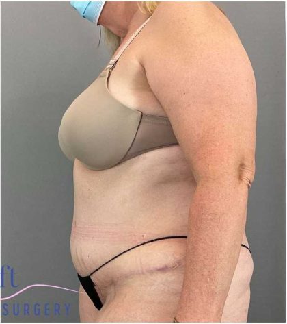Tummy Tuck Before & After Patient #325