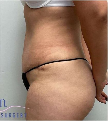 Tummy Tuck Before & After Patient #357