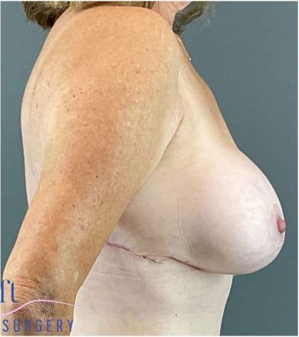 Breast Augmentation Before & After Patient #1613