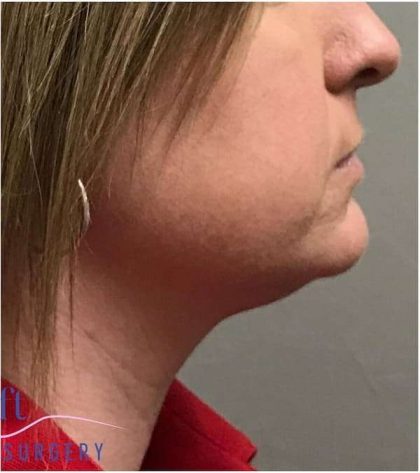Necktite Before & After Patient #1624