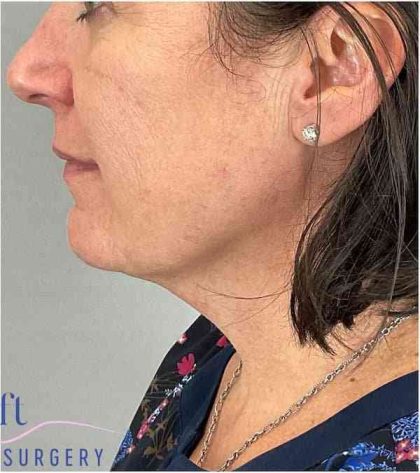 Necktite Before & After Patient #1633