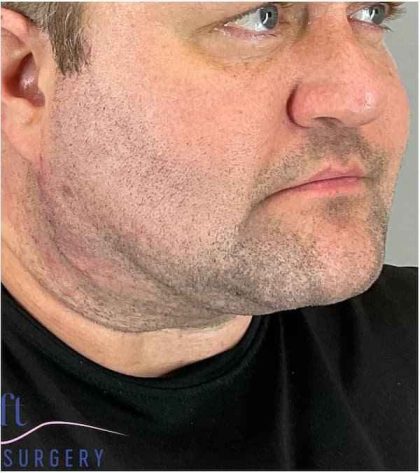 Neck Lift Before & After Patient #1660