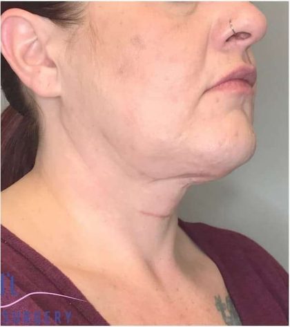 Neck Lift Before & After Patient #1696