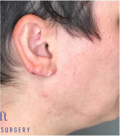 Ear Surgery Before & After Patient #1724