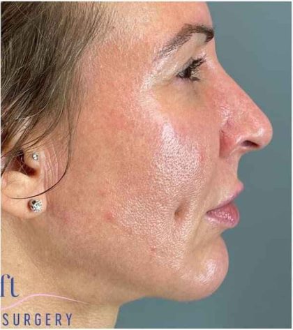 Chin Augmentation Before & After Patient #1747