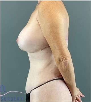 Tummy Tuck Before & After Patient #368