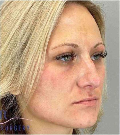 Rhinoplasty Before & After Patient #1807