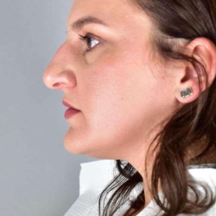 Rhinoplasty Before & After Patient #1818
