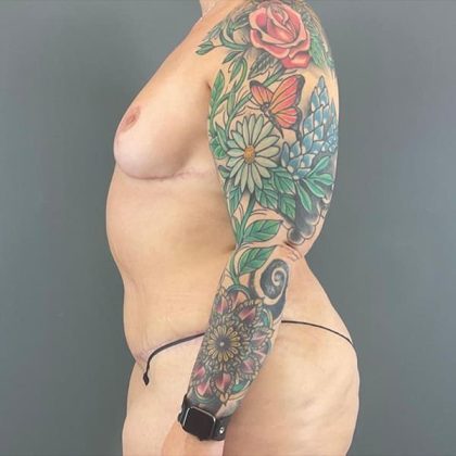 Breast Reduction Before & After Patient #1826