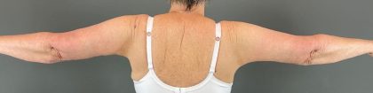 Arm Lift Before & After Patient #219