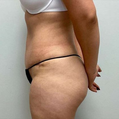 Tummy Tuck Before & After Patient #379