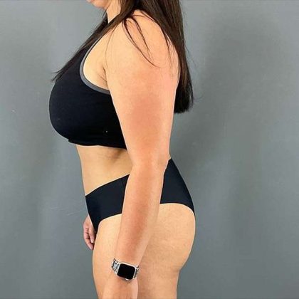 Tummy Tuck Before & After Patient #390