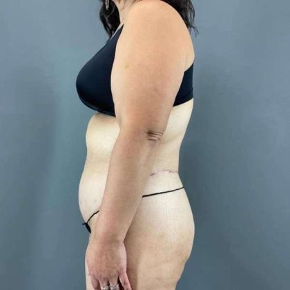 Tummy Tuck Before & After Patient #401