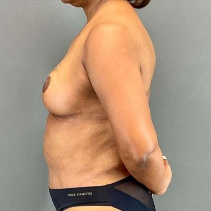 Tummy Tuck Before & After Patient #412