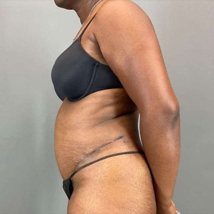 Tummy Tuck Before & After Patient #423