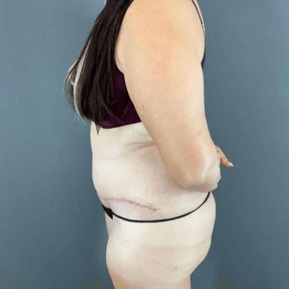 Tummy Tuck Before & After Patient #434