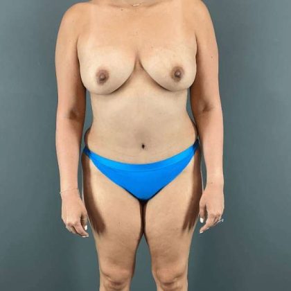 Tummy Tuck Before & After Patient #445