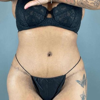 Tummy Tuck Before & After Patient #454