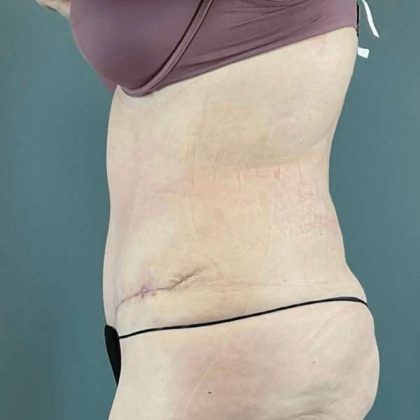 Tummy Tuck Before & After Patient #476