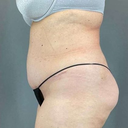 Tummy Tuck Before & After Patient #498