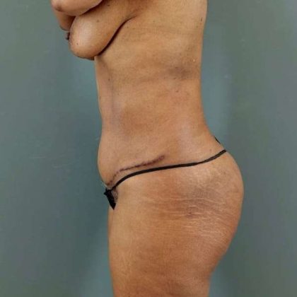Tummy Tuck Before & After Patient #531