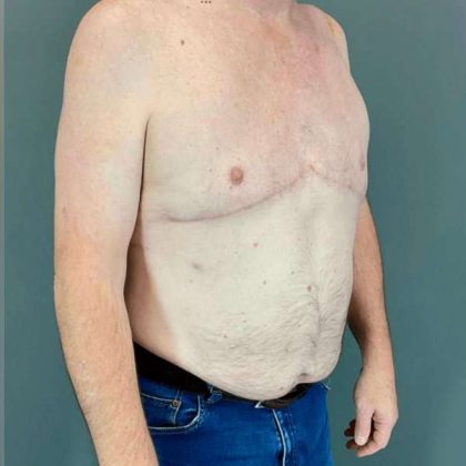 Gynecomastia Before & After Patient #571