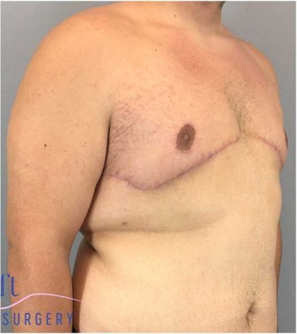 Gynecomastia Before & After Patient #582