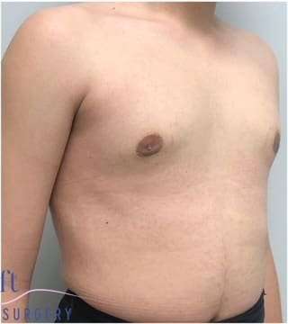 Gynecomastia Before & After Patient #593