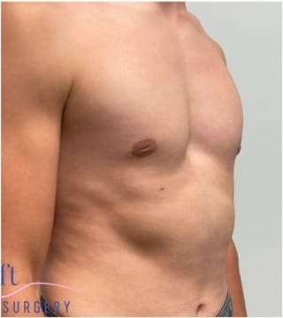 Gynecomastia Before & After Patient #604