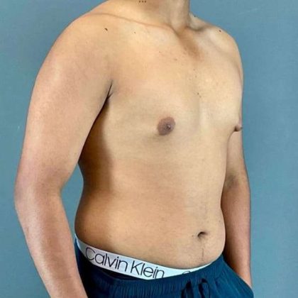 Gynecomastia Before & After Patient #622