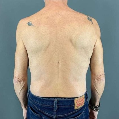 Gynecomastia Before & After Patient #642