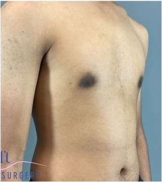 Gynecomastia Before & After Patient #653
