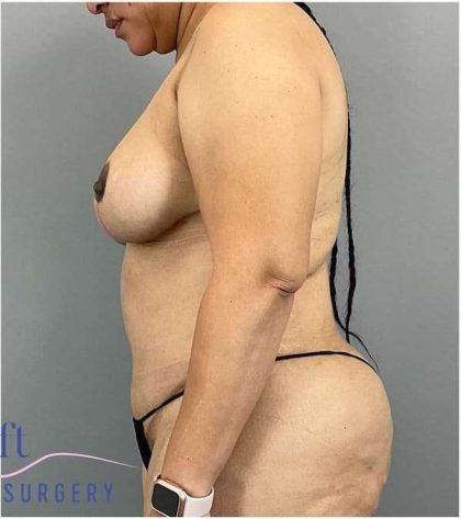 Breast Reduction Before & After Patient #664