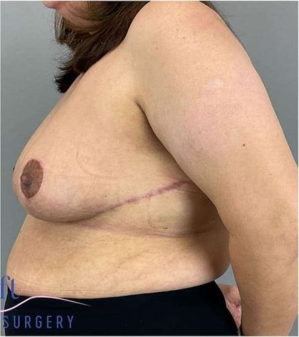 Breast Reduction Before & After Patient #675