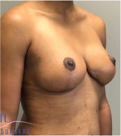 Breast Reduction Before & After Patient #686