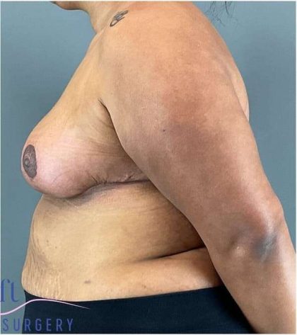 Breast Reduction Before & After Patient #708