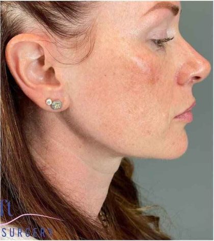 Injectables&Fillers Before & After Patient #118