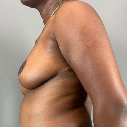 Breast Reduction Before & After Patient #730