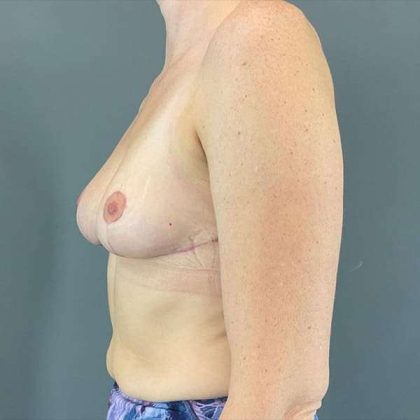Breast Reduction Before & After Patient #741