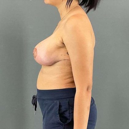 Breast Reduction Before & After Patient #752