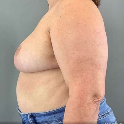 Breast Reduction Before & After Patient #763