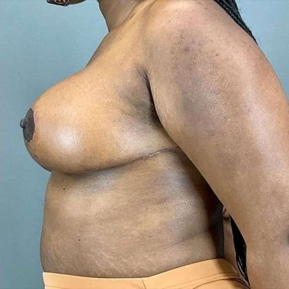 Breast Reduction Before & After Patient #774