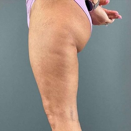 Thigh Lift Before & After Patient #233