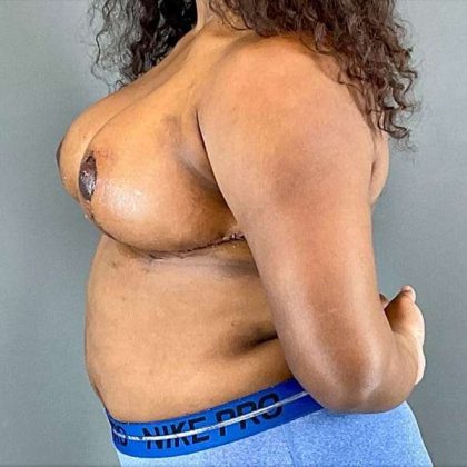 Breast Reduction Before & After Patient #810