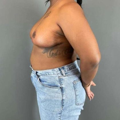 Breast Reduction Before & After Patient #828