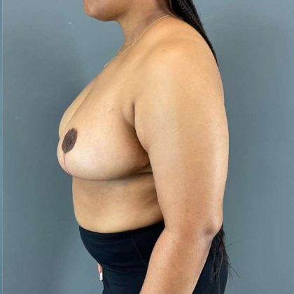 Breast Reduction Before & After Patient #850